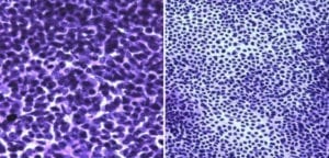 Medulloblastoma microscope Smear showing hypercellularity with small round blue cells and scant cytoplasm