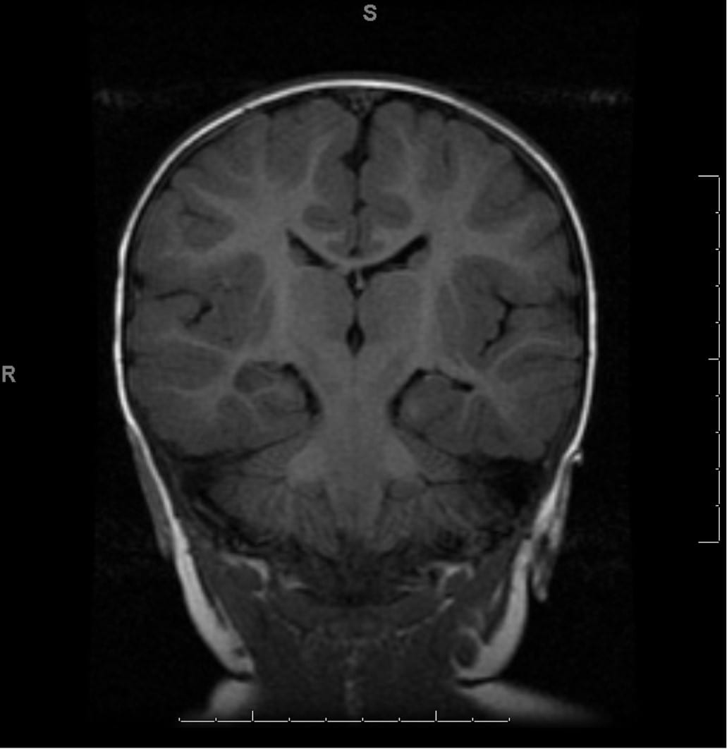 epilepsy patient with mesial temporal sclerosis on MRI