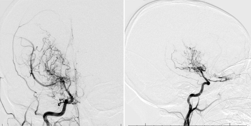 Moyamoya Disease