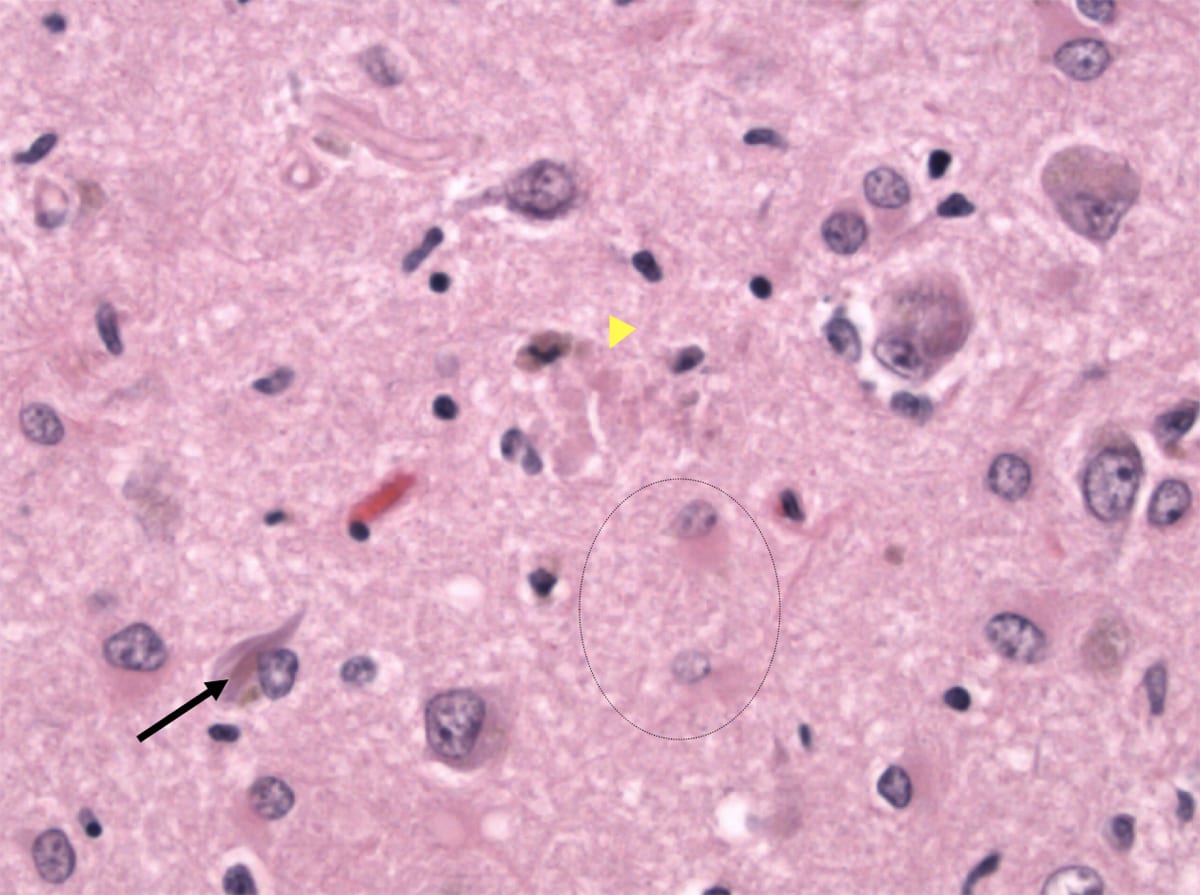 Neurofibrillary tangles on H&E stain