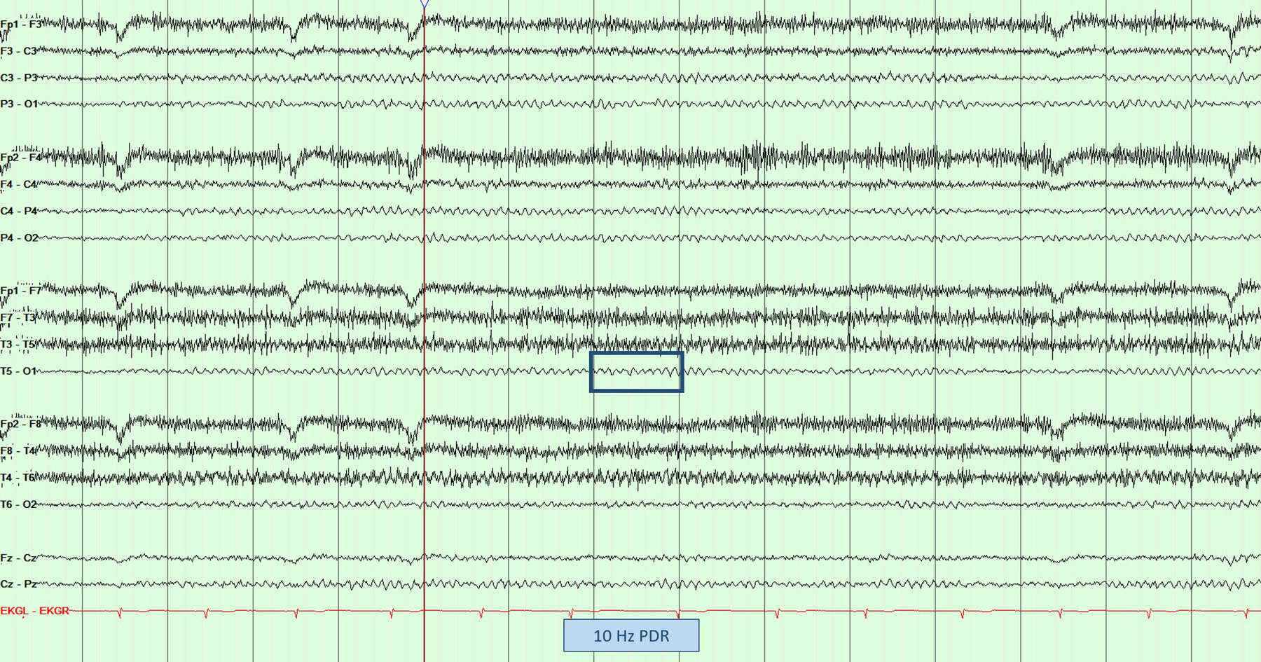 Normal PDR on EEG