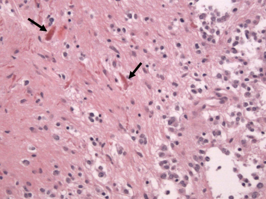 Rosenthal Fibers of Pilocytic Astrocytoma