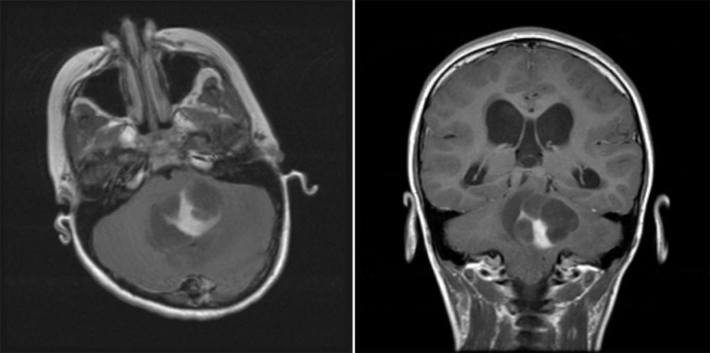 Pilocytic Astrocytoma