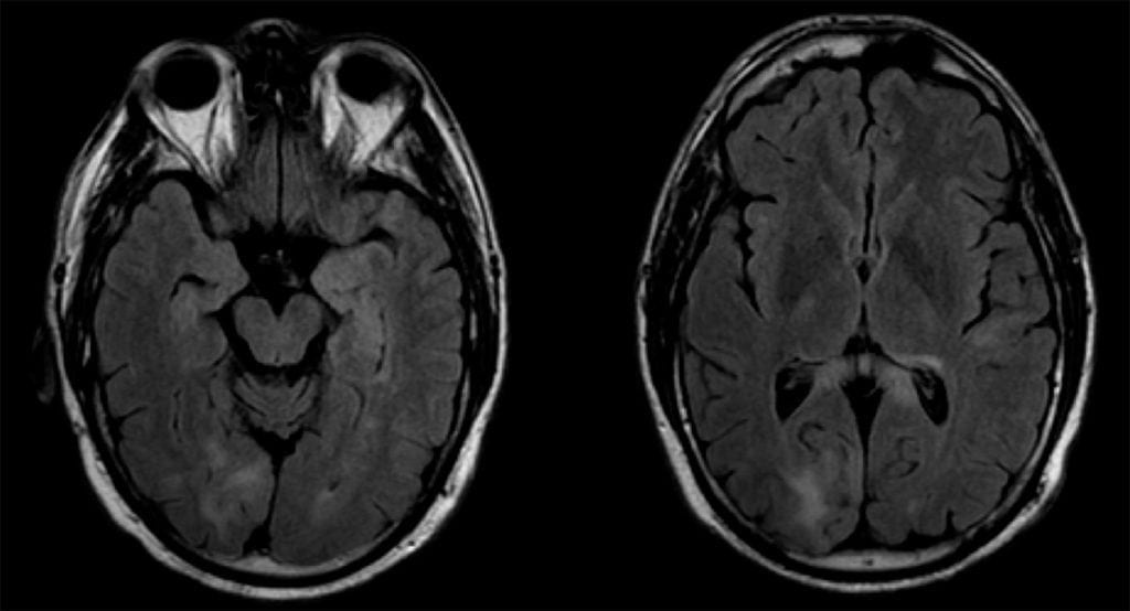 Progressive Multifocal Leukoencephalopathy on brain MRI