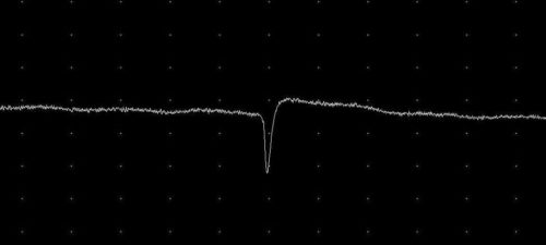 Reading EMG/NCS | Review with Practice Quiz | NowYouKnow Neuro
