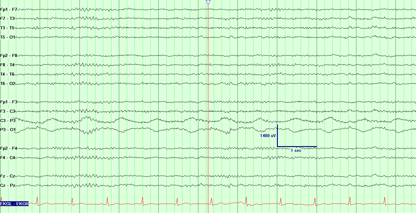 EEG and Sleep Disorders NowYouKnow Neuro