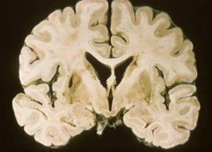 Lacunar Stroke in Right Putamen on coronal gross brain pathology specimen