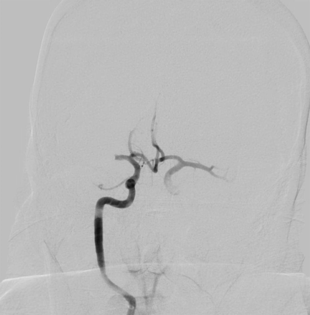 Right MCA Occlusion on cerebral angiogram