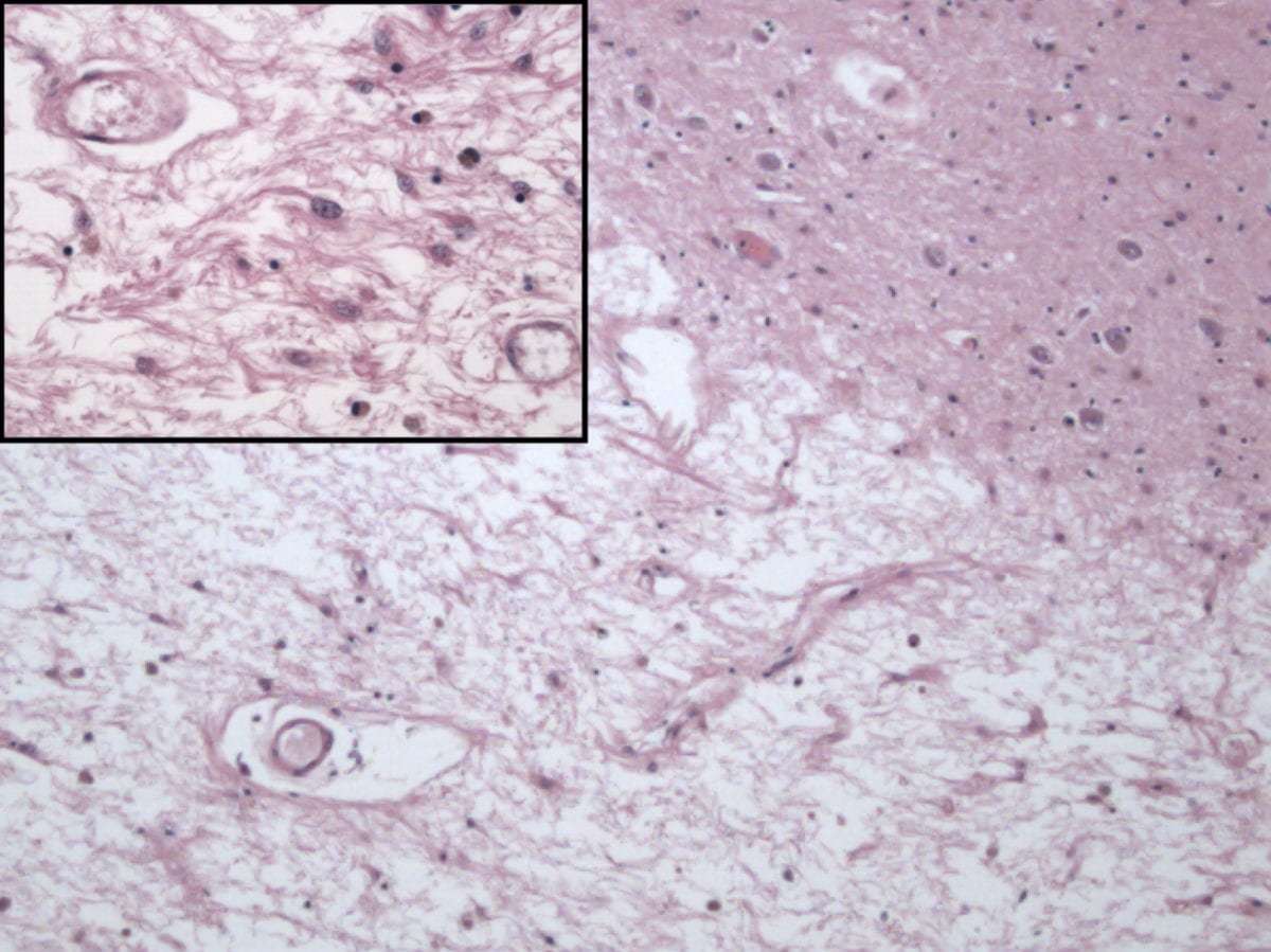 Gliosis after Remote Infarct