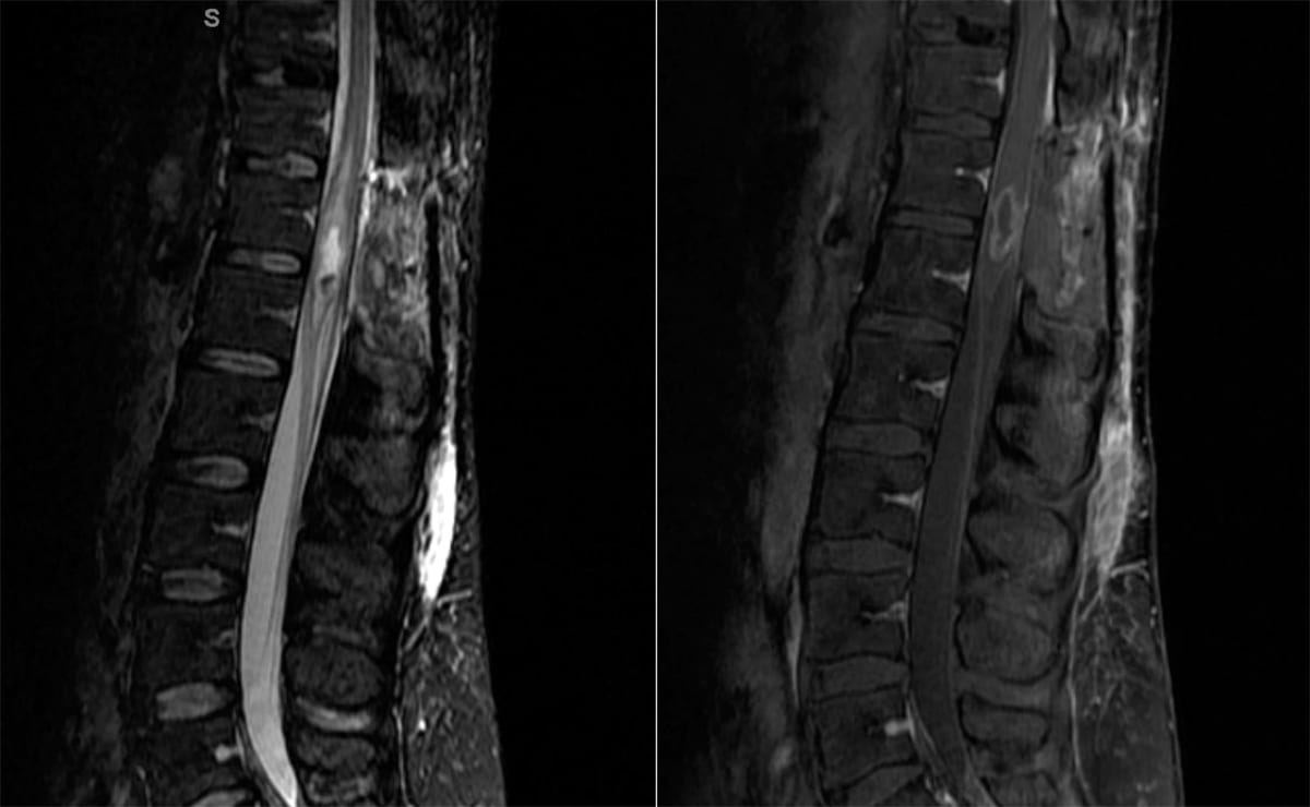 Ependymoma sagittal spine MRI with contrast