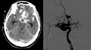 Subarachnoid Hemorrhage from ACA Aneurysm on CT head and angiogram