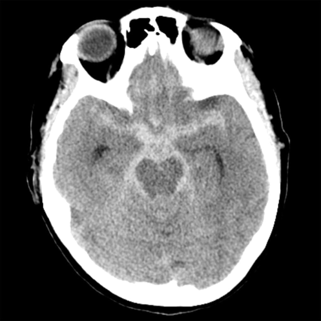 Subarachnoid Hemorrhage with Intraventricular Spread on CT head