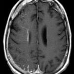 Sturge-Weber Syndrome