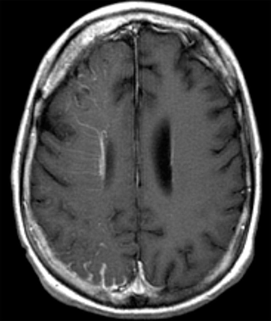 Sturge-Weber Syndrome T1 MRI showing serpiginous hyperintensity and enlarged cortical draining veins