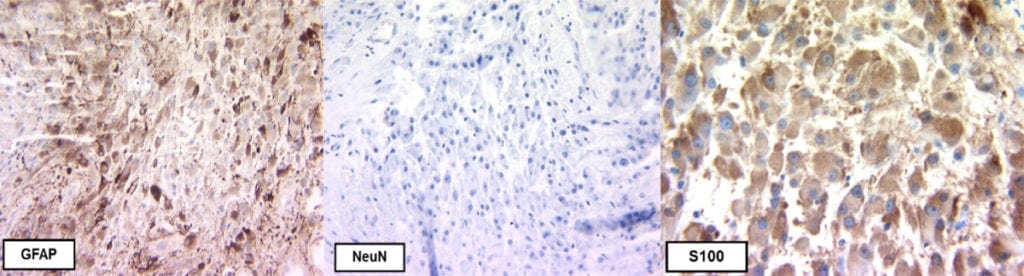 Subependymal Giant Cell Astrocytoma