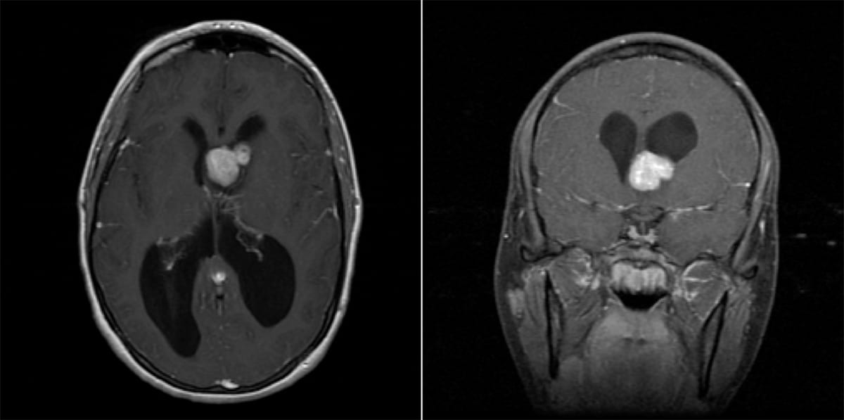 Subependymal Giant Cell Astrocytoma