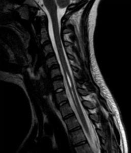 Syringomyelia on T2 sagittal MRI spine
