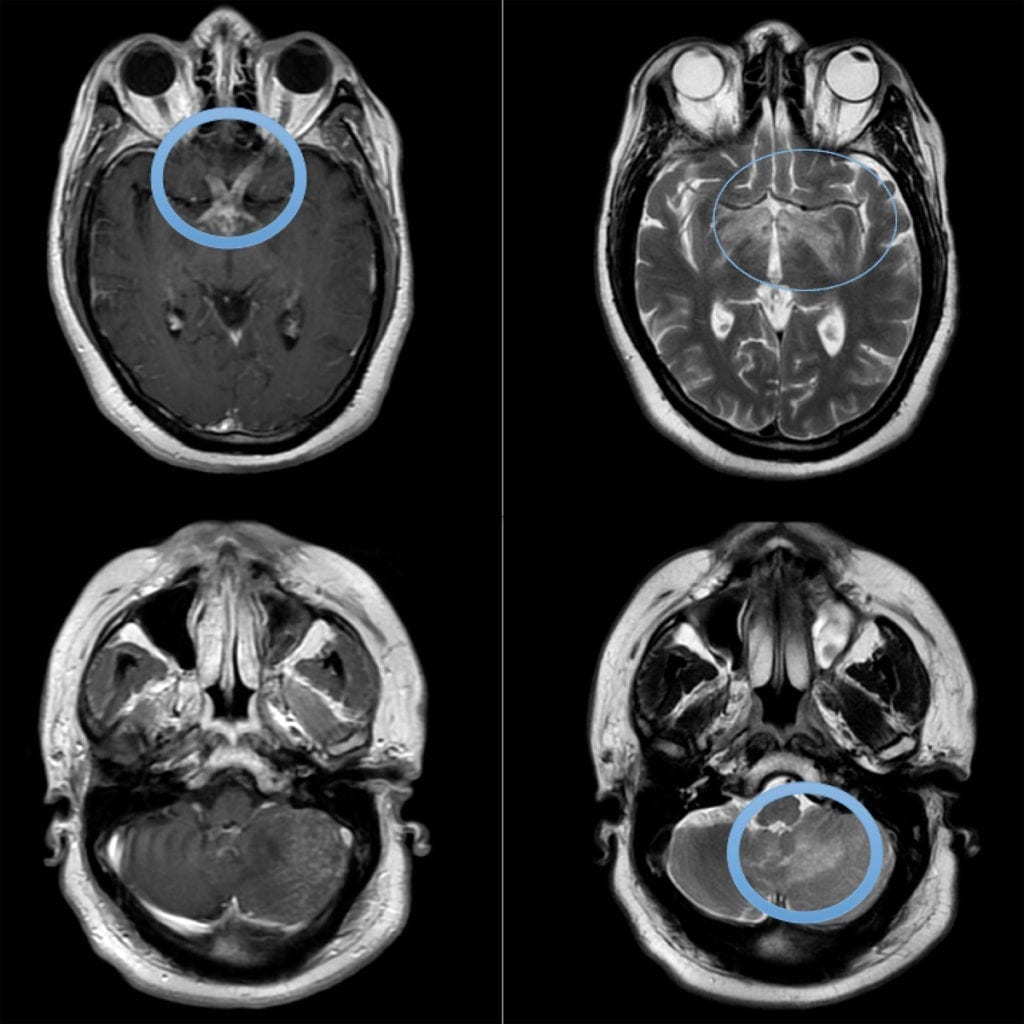 Neurosarcoidosis on MRI brain