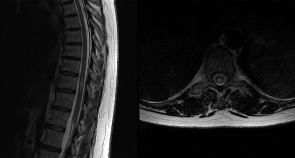Transverse Myelitis sagittal MRI
