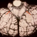 tonsillar_herniation_cerebellum.jpg