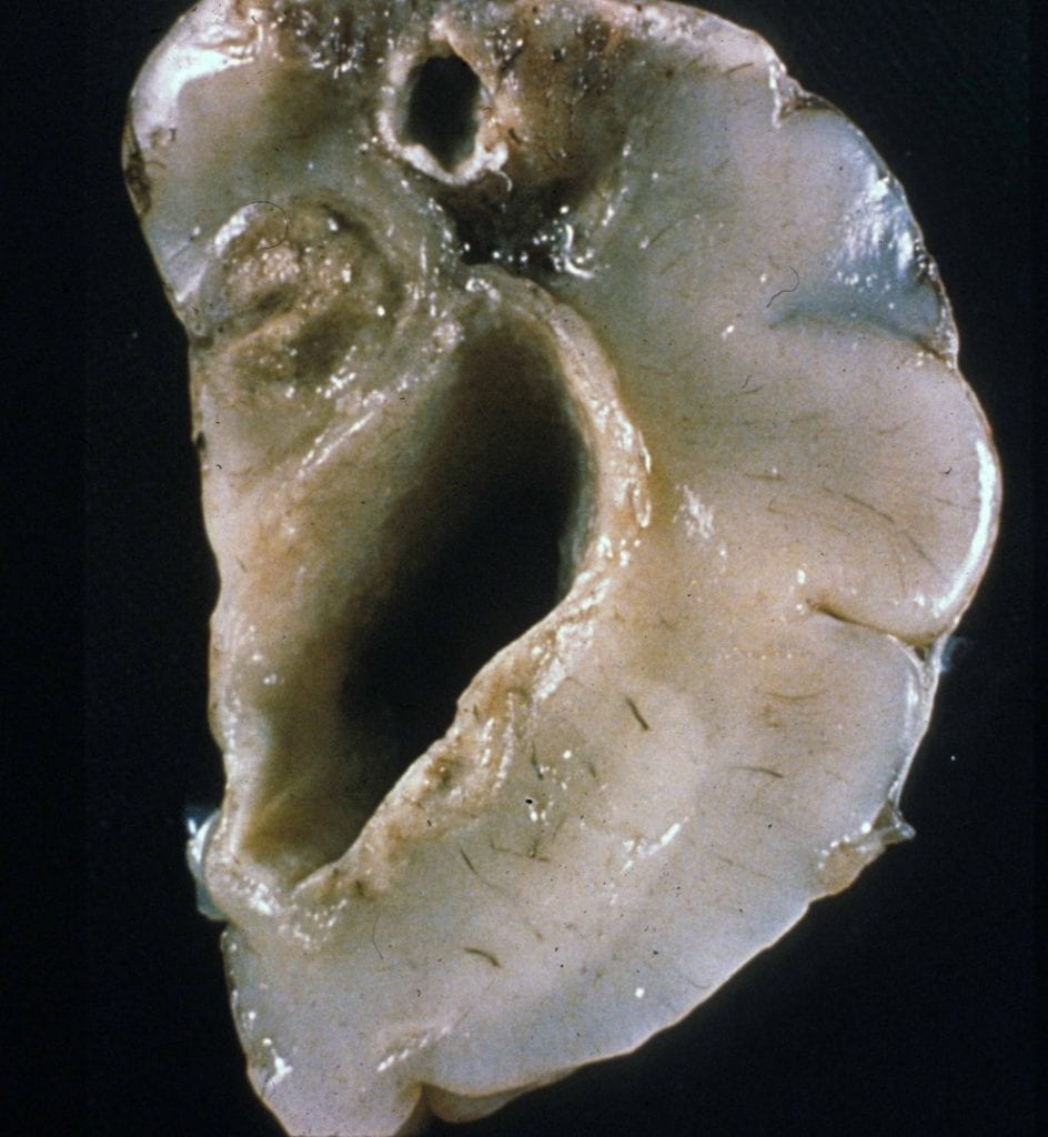 Neuroinfectious Disease congenital toxoplasmosis cortical necrosis