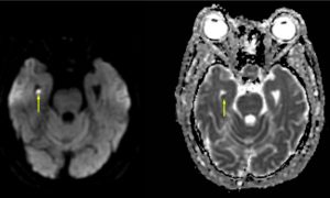 Transient global amnesia on brain MRI