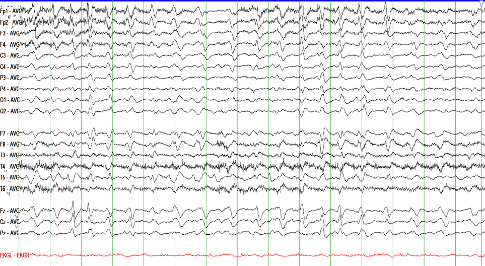 EEG with GPDs with Triphasic Morphology on Average montage, Secondary to hepatic encephalopathy
